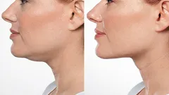 Three Simple Exercises for a Double Chin — You’ll See Results Faster Than You Think
